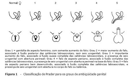 genitalia ambigua - esquizotipia